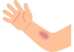 瘀青のイラスト